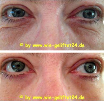 Ultimate Young - Anti-Aging der neuen Art Faltenfrei in wenigen Minuten